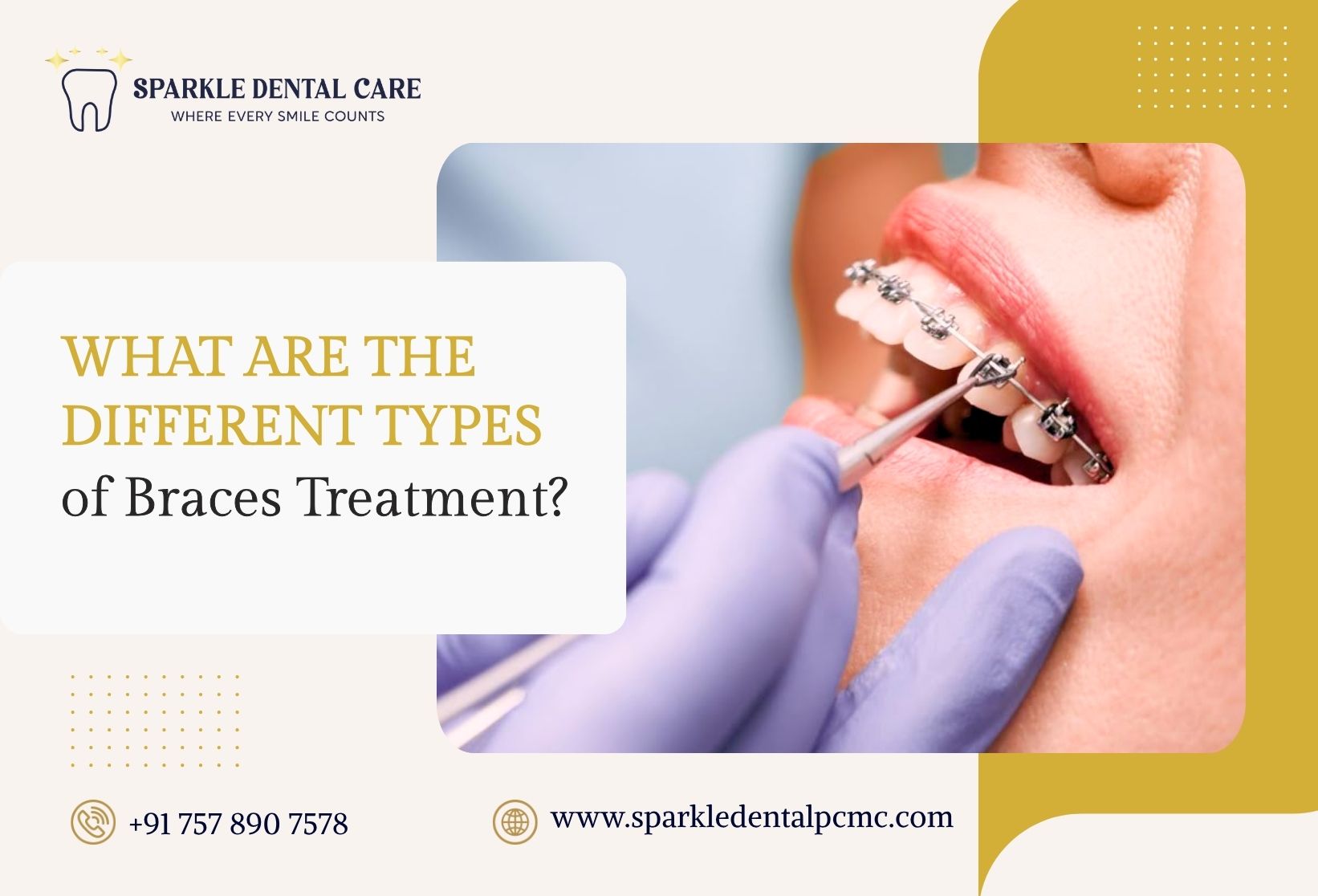 What Are The Different Types of Braces Treatment Available?